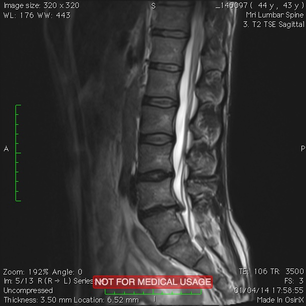 Bulgingdisc